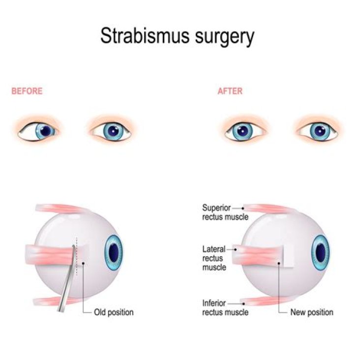 Is Strabismus surgery necessary?