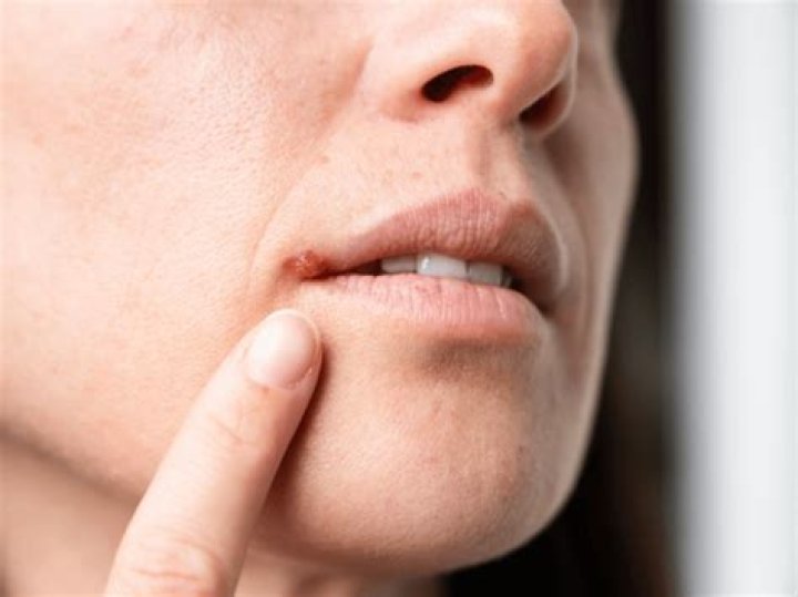 Is there a cure to Marcel's bite?