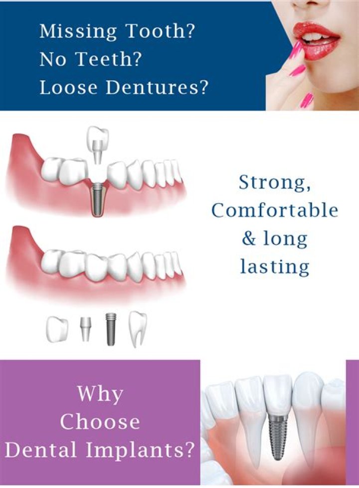 Is tooth implant permanent?