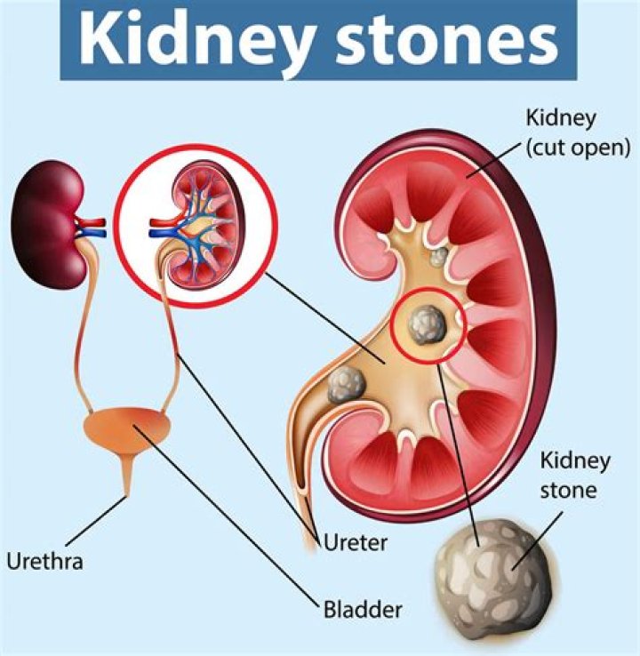 Is Tuna good for kidney stones?