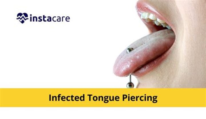Is yellow discharge normal after tongue piercing?