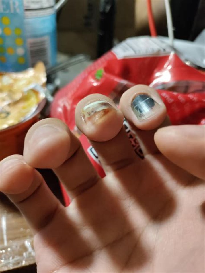 Should I cut off detached nail?