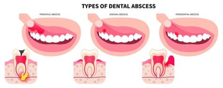 Should I go to the ER for a dental abscess?