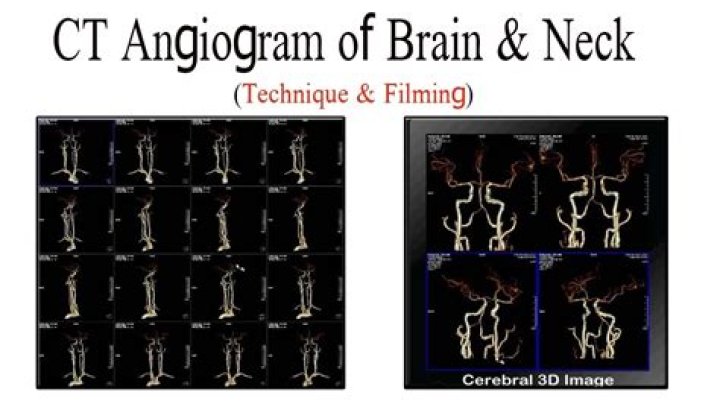 Should I have a CT angiogram?