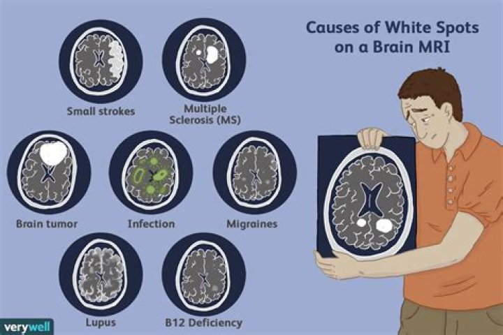 Should I worry about white spots on brain?