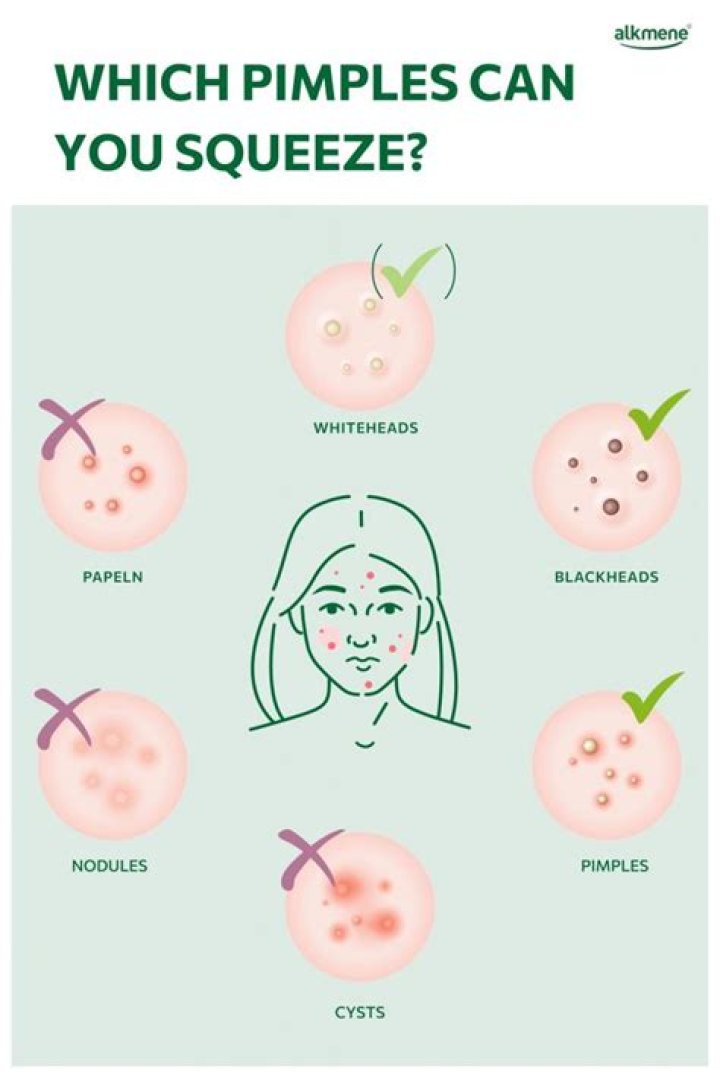 Should you squeeze whiteheads?