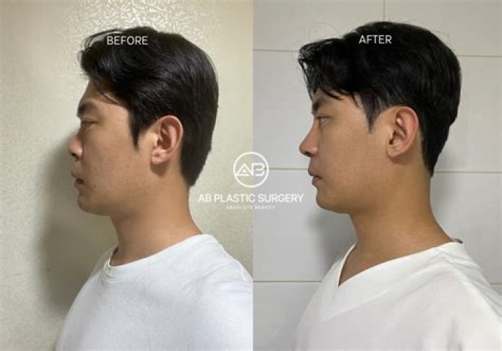 What age can you get a nose job in Korea?