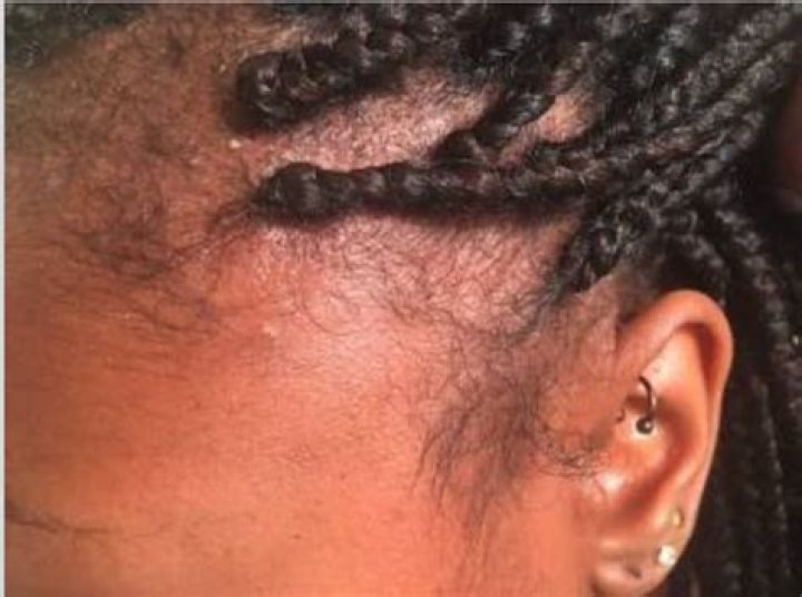 What are braid bumps?