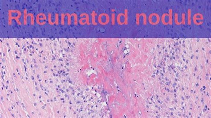 What are inflammatory nodules?