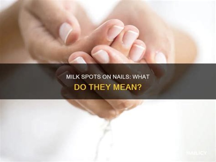 What are milk spots on nails?