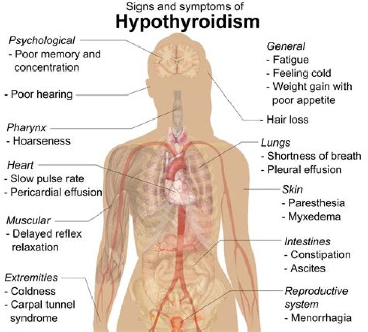 What are severe symptoms of hypothyroidism?