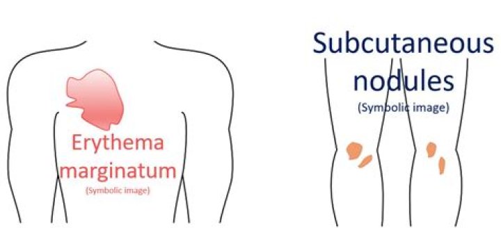 What are subcutaneous nodules?