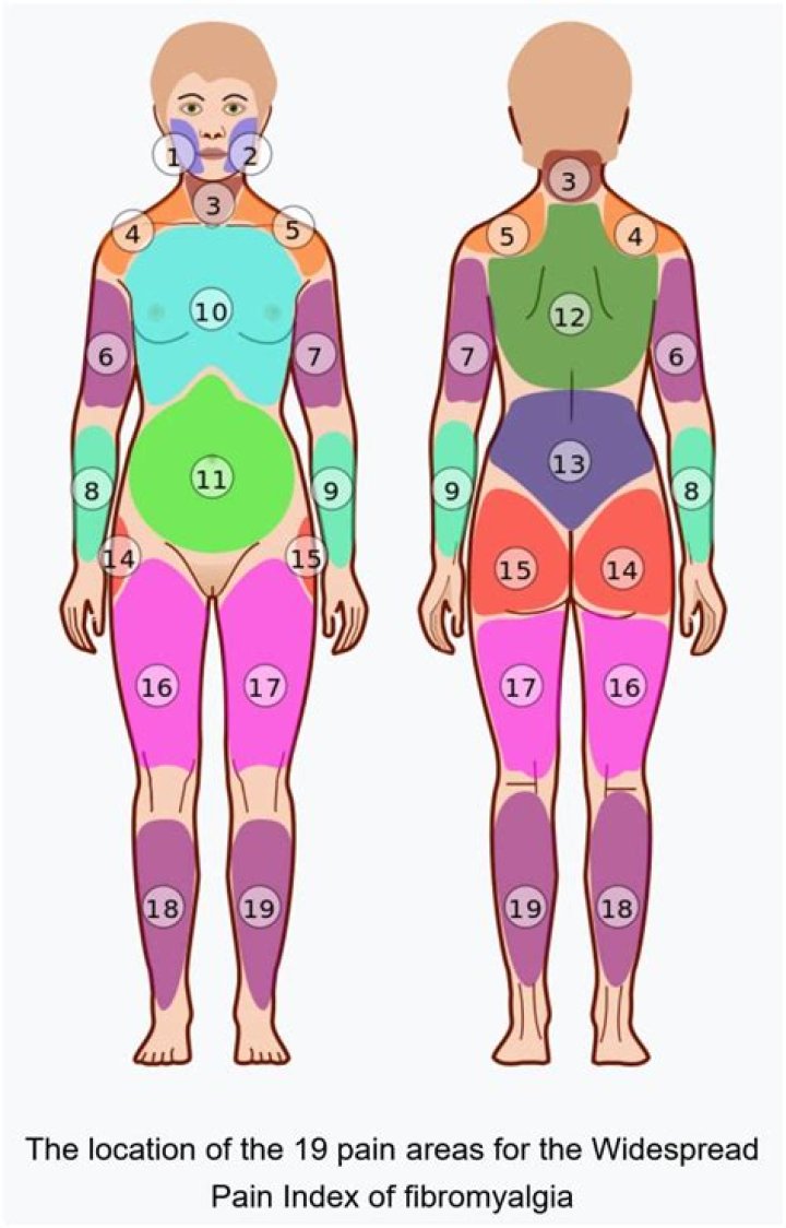 What are the 5 regions of pain for fibromyalgia?