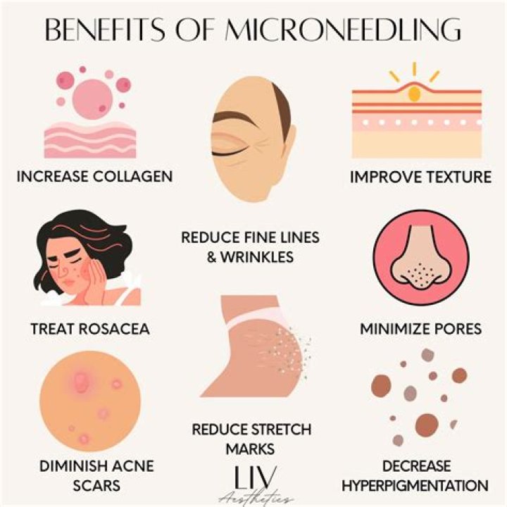 What are the benefits of microneedling?