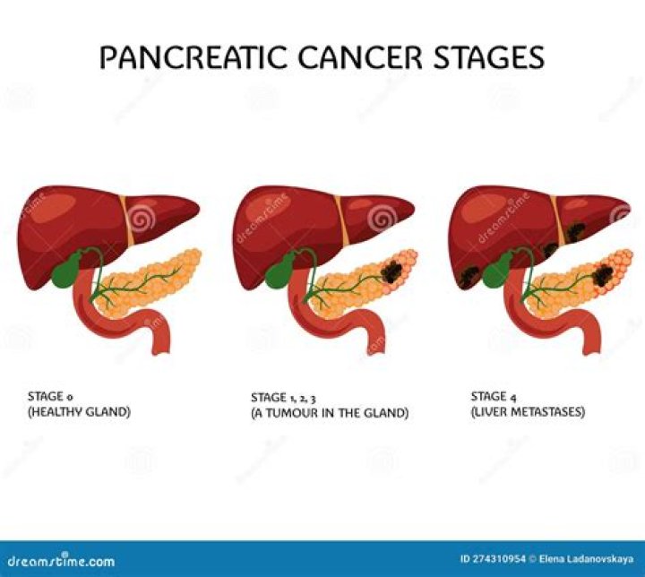 What are the end stages of pancreatitis?