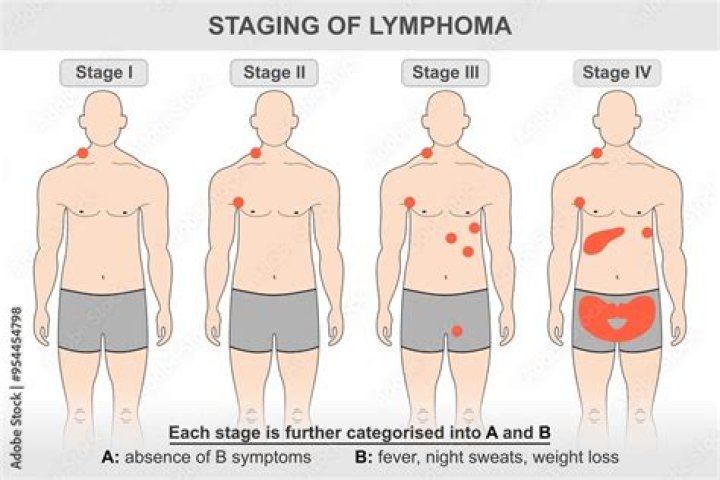 What are the final stages of lymphoma?