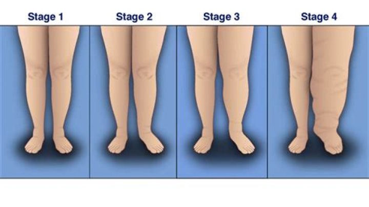 What are the four stages of lymphedema?