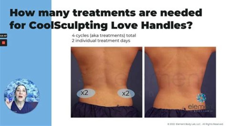 What are the negatives of CoolSculpting?