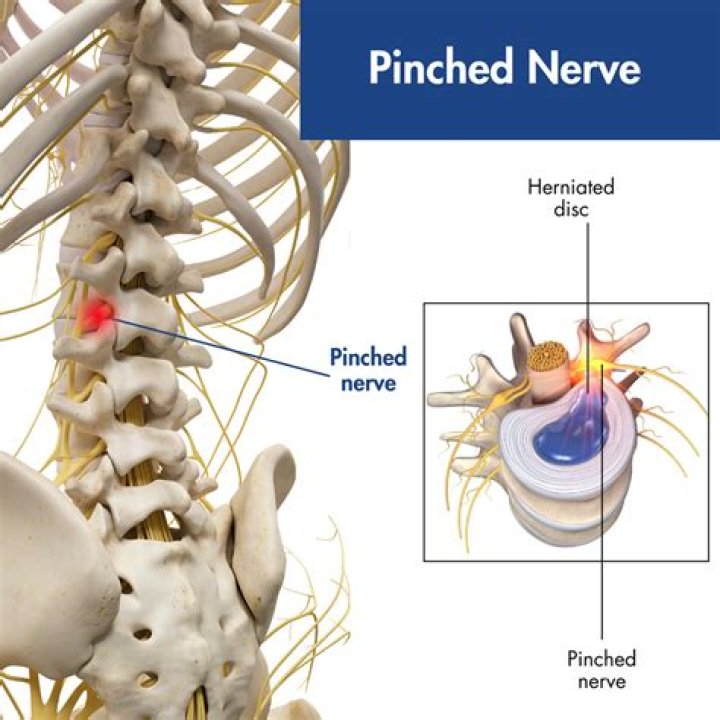 What are the symptoms of a pinched nerve at C5 C6?