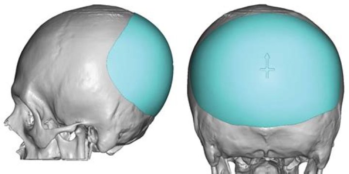 What are the two bumps at the base of my skull?