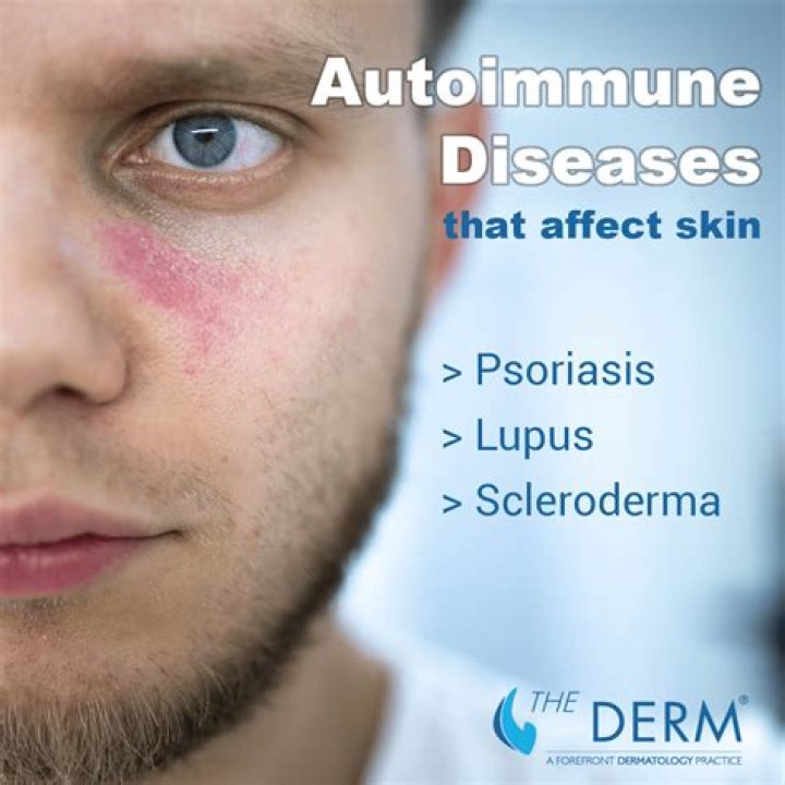 What autoimmune disease causes itchy skin?