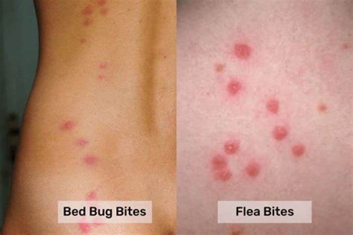 What bites look like pimples?