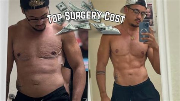 What BMI do you need for top surgery?