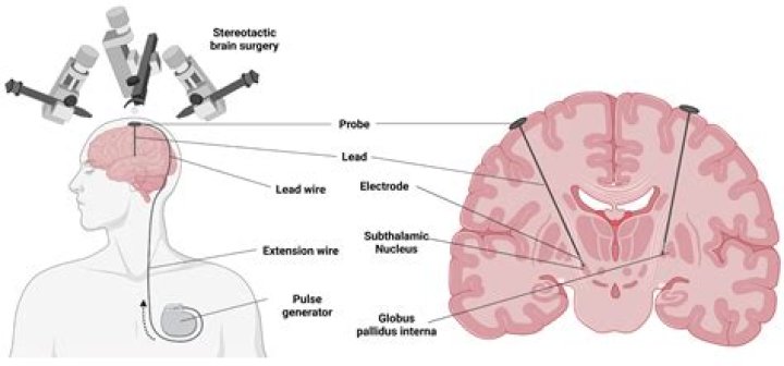 What brain surgery feels like?