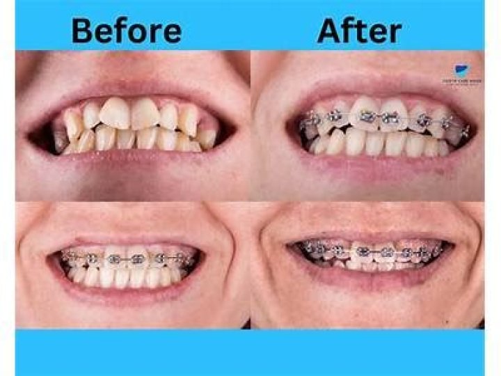 What can braces not fix?