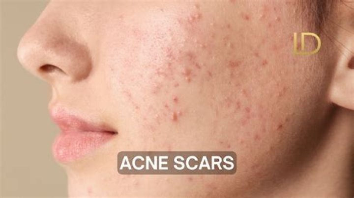 What can make acne scars worse?