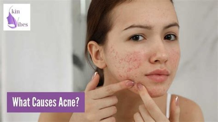 What can worsen acne?