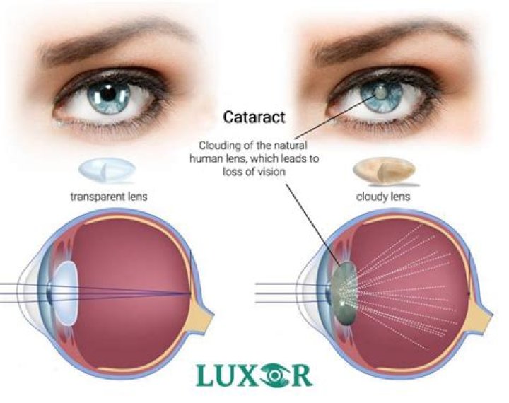 What causes a cataract to grow fast?