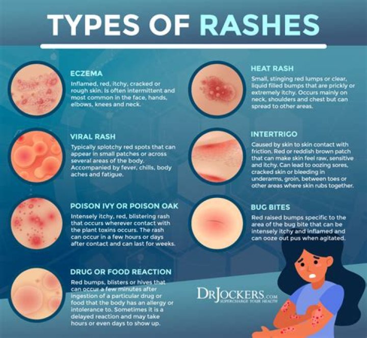 What causes a rash to spread?