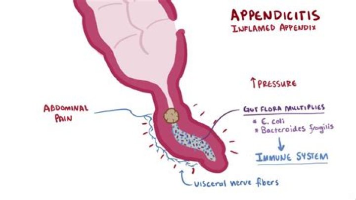 What causes appendix to burst?