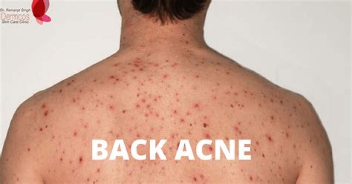 What causes back acne?