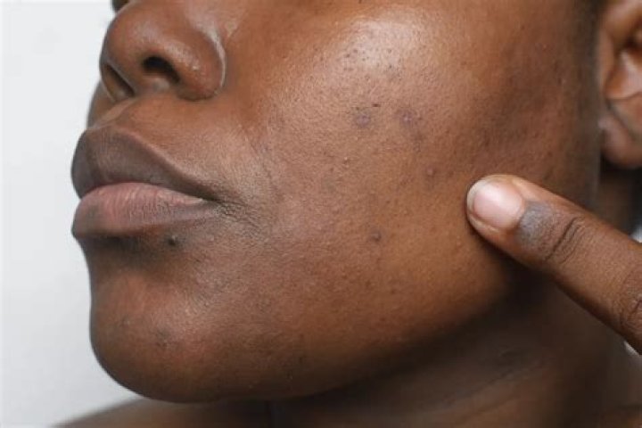 What causes black spot inside cheek?