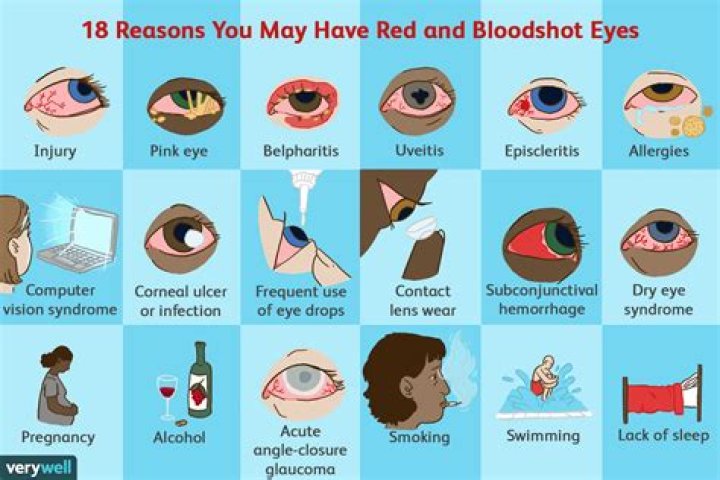 What causes bloodshot eyes?