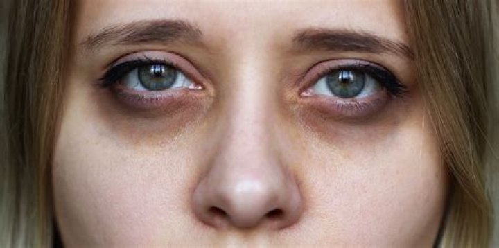 What causes dark circles around the eyes in adults?