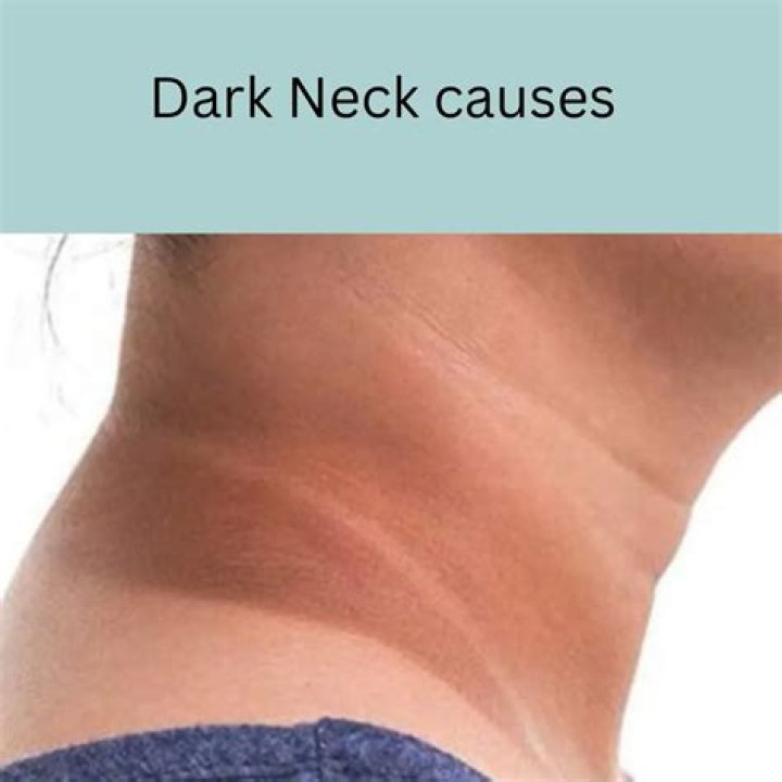 What causes dark neck during pregnancy?