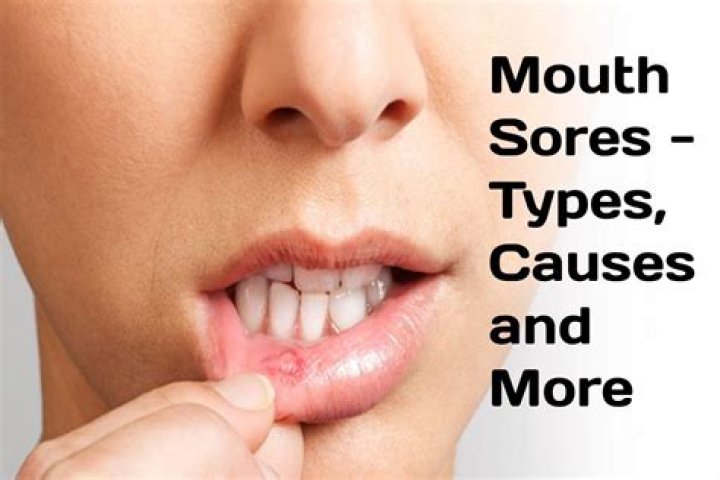 What causes inside mouth sores?