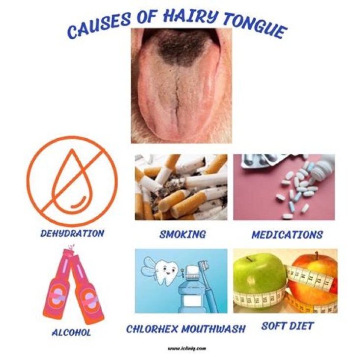 What causes white hairy tongue?