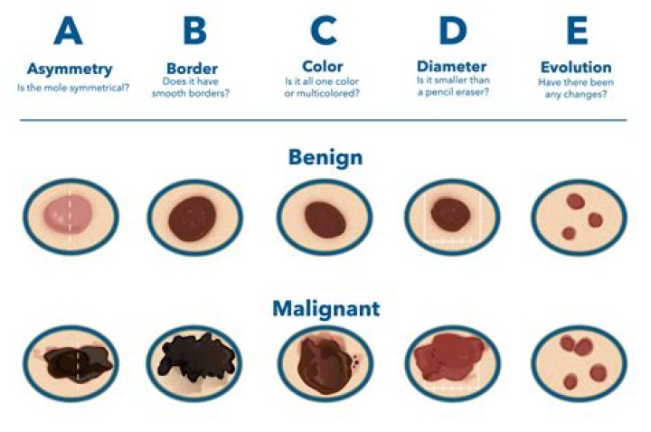 What color are cancerous moles?