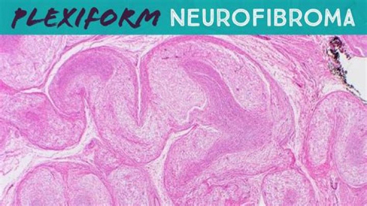 What color are neurofibromas?
