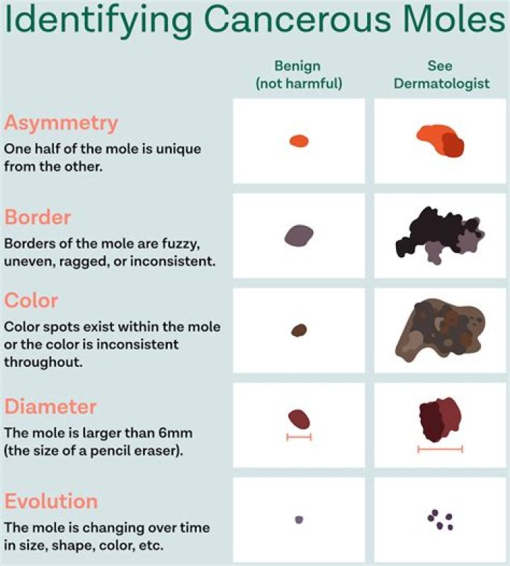 What color mole is cancerous?