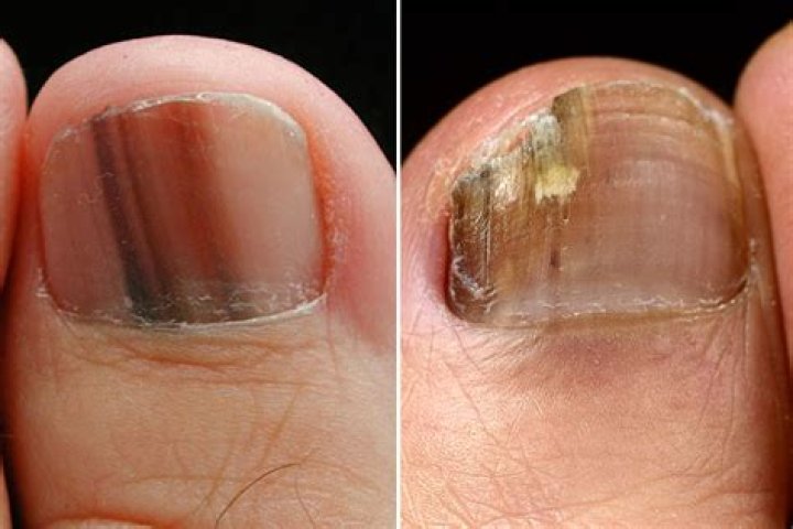 What destroys toenail fungus?