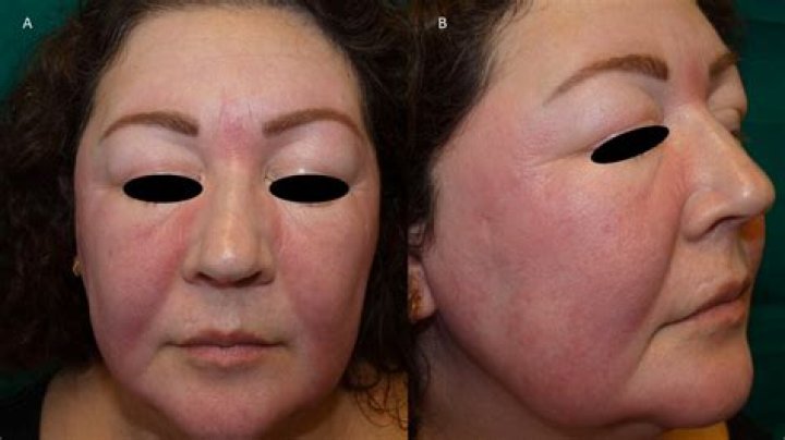 What disease causes facial swelling?