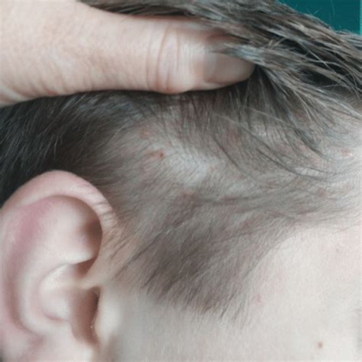 What do lice bites look like on scalp?