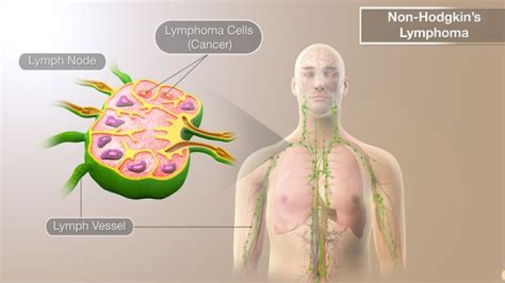 What do lymphoma tumors look like?