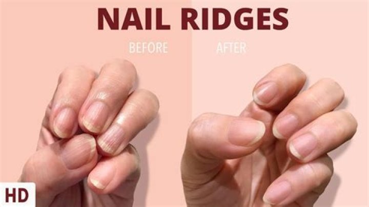 What do ridges in your nails mean?