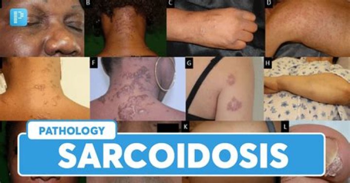 What do sarcoidosis lesions look like?